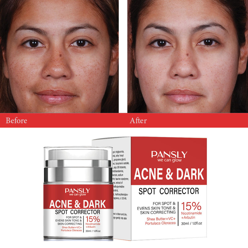Strong Removal Melasma Whitening Dark Acne Spot Corrector Cream Freckle Sunburn