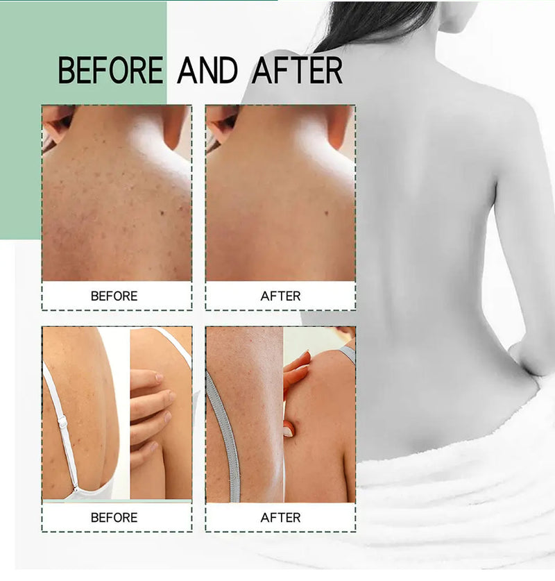 Body Acne Spray Back Acne Treatment 100ml 2% Salicylic Acid Clear Spots