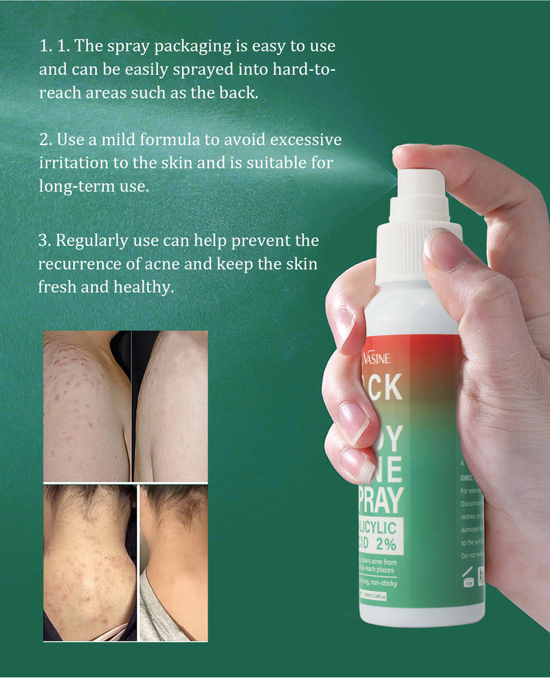 Body Acne Spray Back Acne Treatment 100ml 2% Salicylic Acid Clear Spots