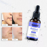 Retinol Face Serum + Vitamin E 30 ml Neutriherbs For Micro Needle Derma Roller